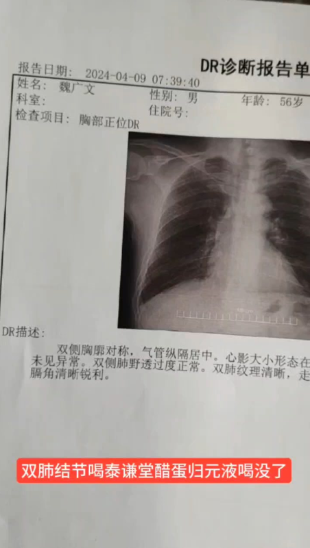 图片[1]-【视频】双肺结节喝泰谦堂醋蛋归元液喝没了-醋蛋液案例交流分享圈子社区-智健家