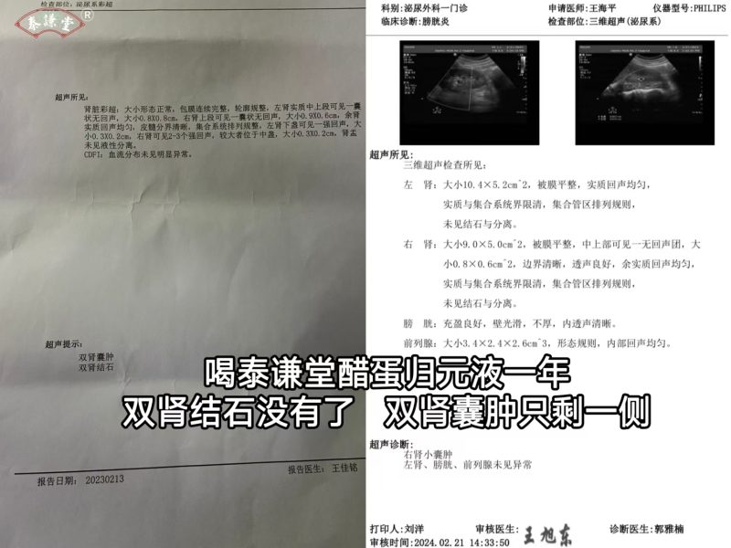 图片[1]-喝泰谦堂醋蛋液一年，双肾结石没了，双肾囊肿只剩一侧-醋蛋液案例交流分享圈子社区-智健家