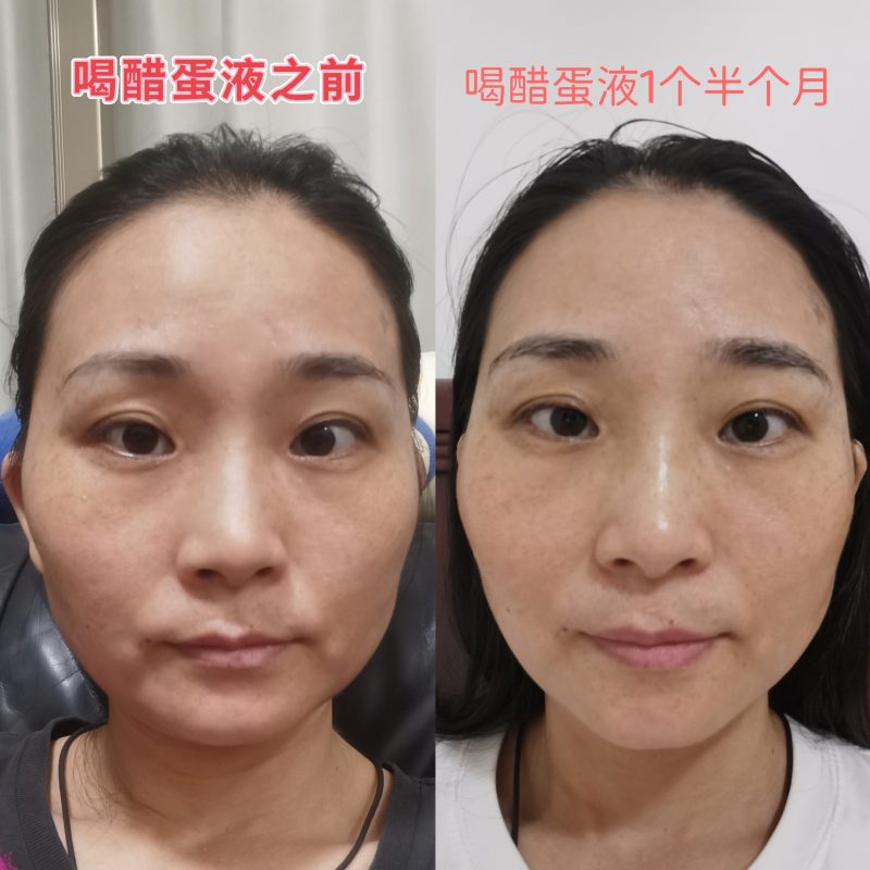 图片[1]-喝泰谦堂醋蛋归元液1个半月，内服外用脸明显瘦了也紧致了，化妆品也不用啦~-醋蛋液案例交流分享圈子社区-智健家