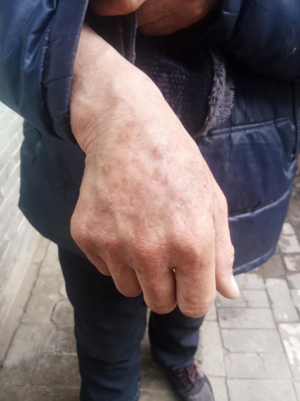 图片[4]-患有毛囊炎1 年了，而且脖子上和手上患有神经性皮炎有十来年了发痒流脓水实在是难以忍受，服用醋蛋液10天就有效果了-醋蛋液案例交流分享圈子社区-智健家