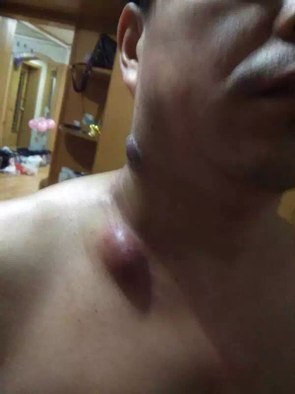 图片[2]-淋巴结节 喝泰谦堂醋蛋归元液两个疗程的结果-醋蛋液案例交流分享圈子社区-智健家