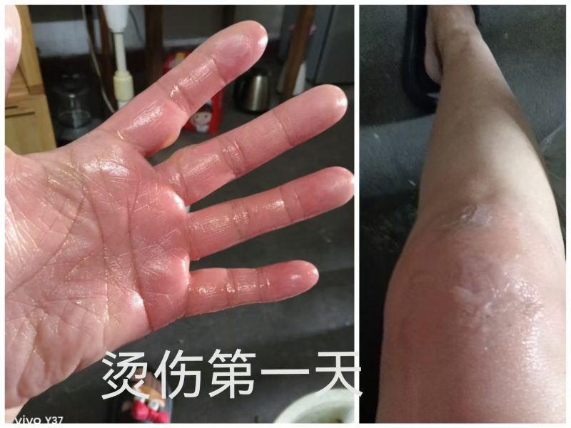 图片[1]-烫伤 醋蛋归元液内服加外抹 10天的变化过程-醋蛋液案例交流分享圈子社区-智健家
