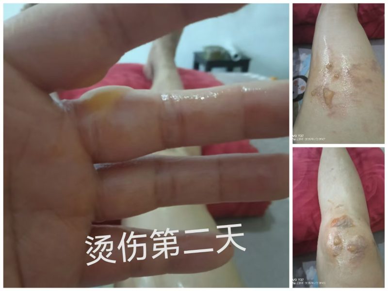 图片[2]-烫伤 醋蛋归元液内服加外抹 10天的变化过程-醋蛋液案例交流分享圈子社区-智健家