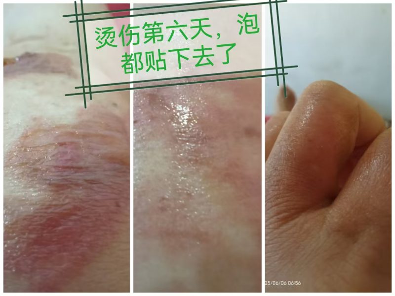 图片[3]-烫伤 醋蛋归元液内服加外抹 10天的变化过程-醋蛋液案例交流分享圈子社区-智健家