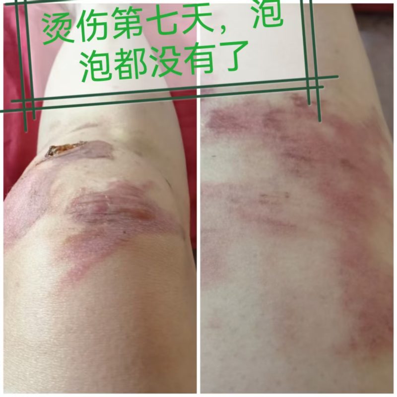 图片[4]-烫伤 醋蛋归元液内服加外抹 10天的变化过程-醋蛋液案例交流分享圈子社区-智健家