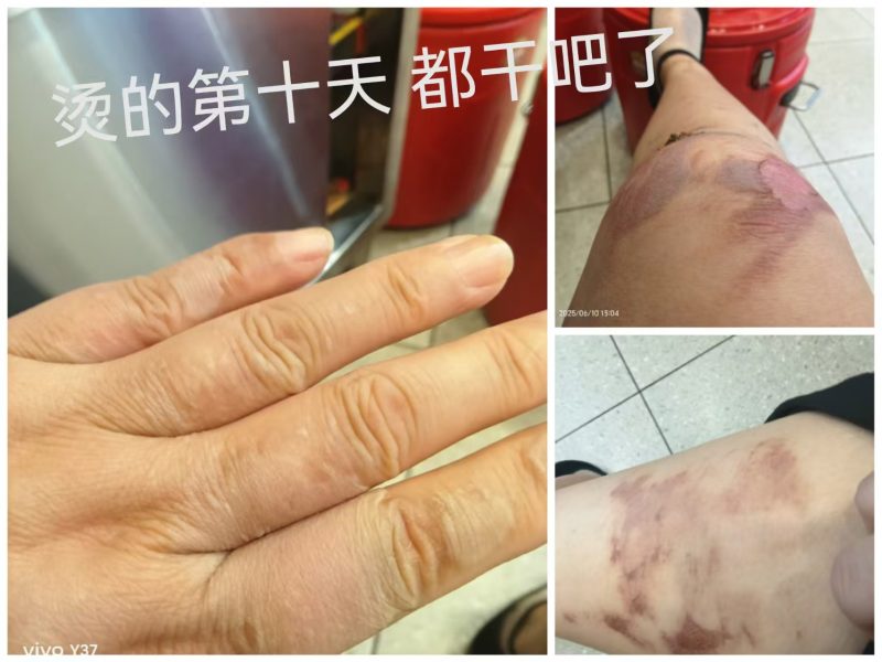 图片[5]-烫伤 醋蛋归元液内服加外抹 10天的变化过程-醋蛋液案例交流分享圈子社区-智健家