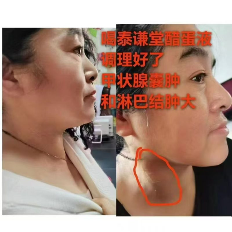 图片[1]-喝泰谦堂醋蛋液调理好了甲状腺囊肿和淋巴结肿大-醋蛋液案例交流分享圈子社区-智健家