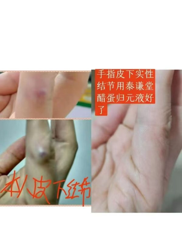 图片[1]-手指皮下实性结节用泰谦堂醋蛋归元液好了-醋蛋液案例交流分享圈子社区-智健家