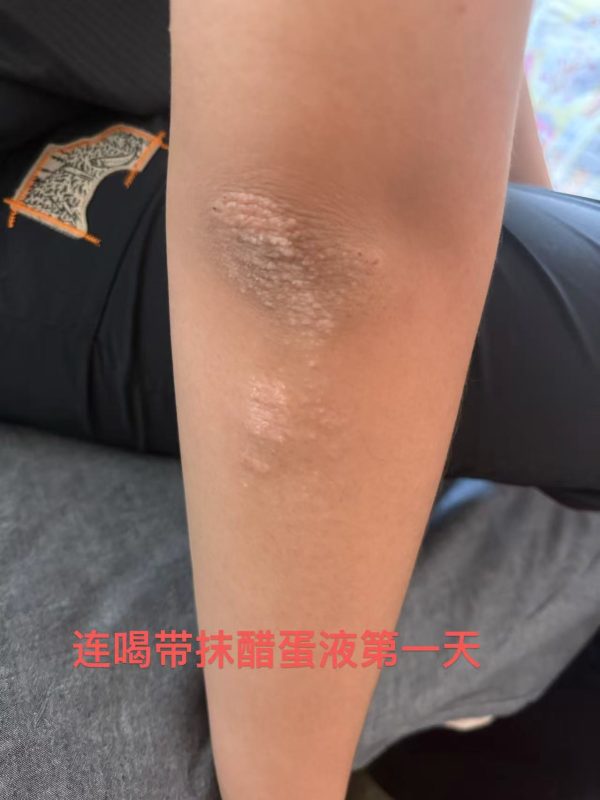 图片[1]-皮炎反反复复孩子一直不好，泰谦堂醋蛋液连喝带抹，外用抹的原液，5天感觉好很多。-醋蛋液案例交流分享圈子社区-智健家