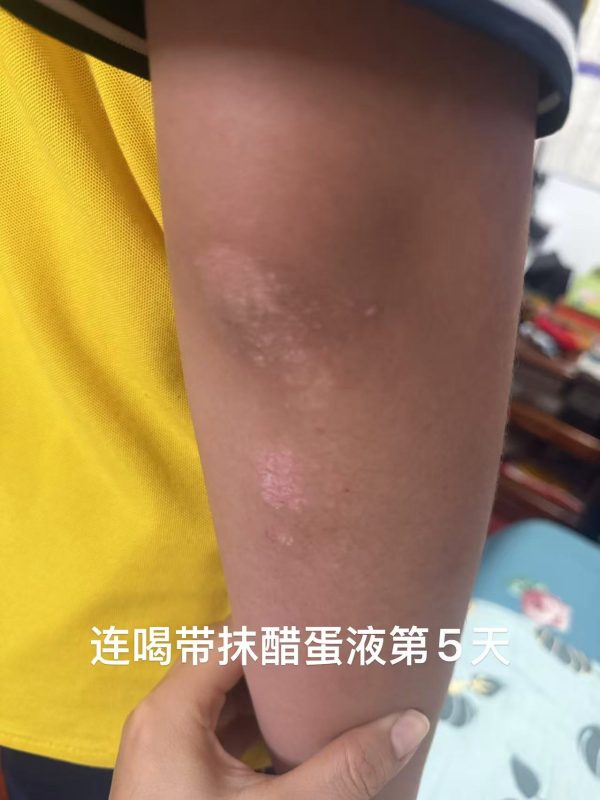 图片[2]-皮炎反反复复孩子一直不好，泰谦堂醋蛋液连喝带抹，外用抹的原液，5天感觉好很多。-醋蛋液案例交流分享圈子社区-智健家