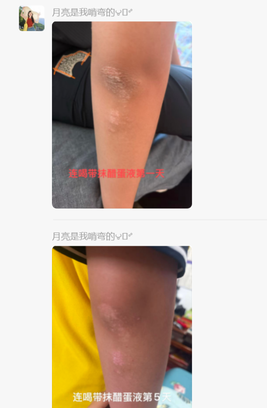 图片[3]-皮炎反反复复孩子一直不好，泰谦堂醋蛋液连喝带抹，外用抹的原液，5天感觉好很多。-醋蛋液案例交流分享圈子社区-智健家