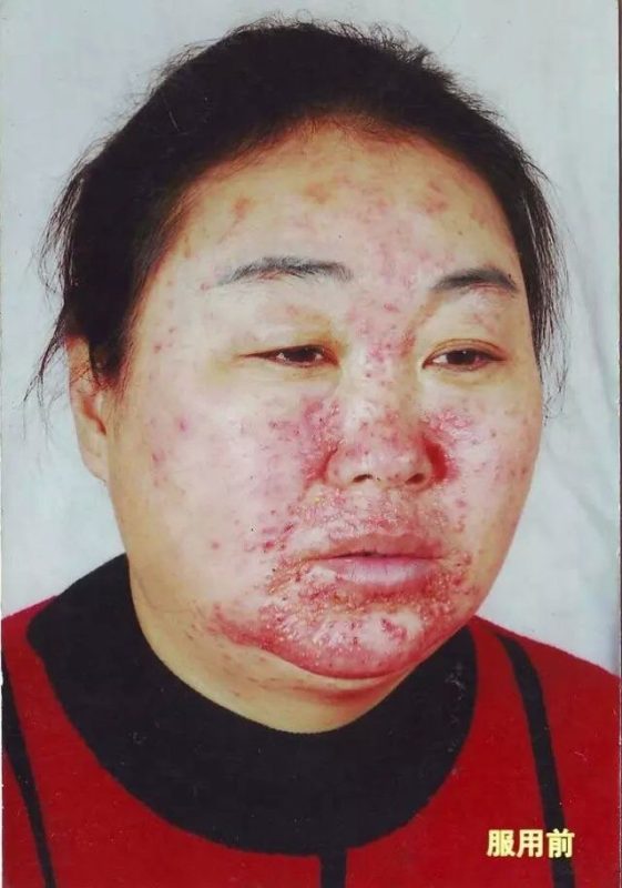 图片[1]-来自东北的照金鸿老师，曾经常年做屋顶防水处理，导致皮肤严重过敏等情况，醋蛋归元液服用7个月后完全恢复了正常。-醋蛋液案例交流分享圈子社区-智健家