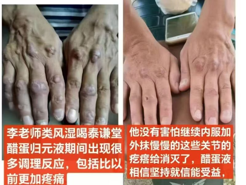 图片[1]-类风湿连喝带抹泰谦堂醋蛋液，关节的疙瘩也消灭了-醋蛋液案例交流分享圈子社区-智健家