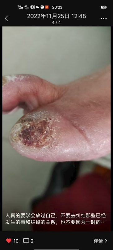 图片[4]-吴老师妈妈是糖尿病并发症患者，通过喝和涂抹泰谦堂醋蛋液神奇的恢复了健康，保住了自己的脚。-醋蛋液案例交流分享圈子社区-智健家