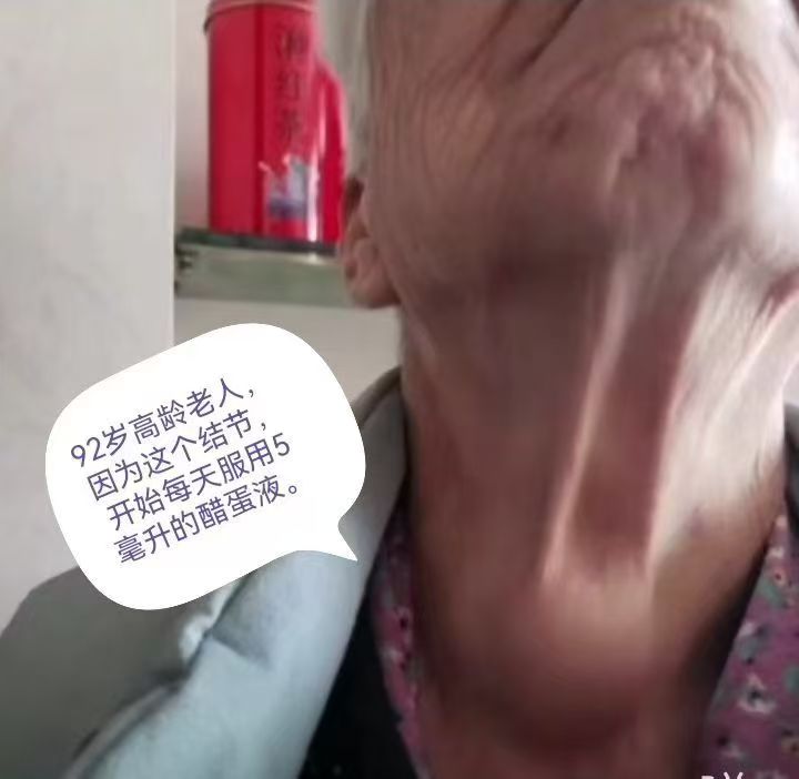 图片[1]-92岁高龄老人，因脖子上有个疙瘩结节，醋蛋液连喝带抹，疙瘩结节越来越小了-醋蛋液案例交流分享圈子社区-智健家