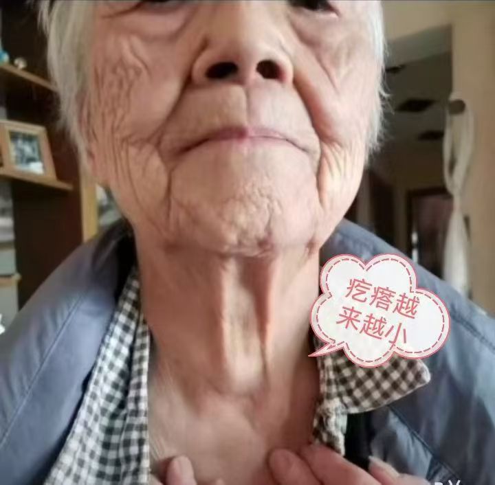 图片[2]-92岁高龄老人，因脖子上有个疙瘩结节，醋蛋液连喝带抹，疙瘩结节越来越小了-醋蛋液案例交流分享圈子社区-智健家