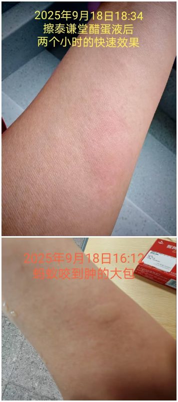 图片[3]-蚊虫叮咬，咬的大包，涂抹泰谦堂醋蛋液，2个多小时后快速解毒的效果-醋蛋液案例交流分享圈子社区-智健家