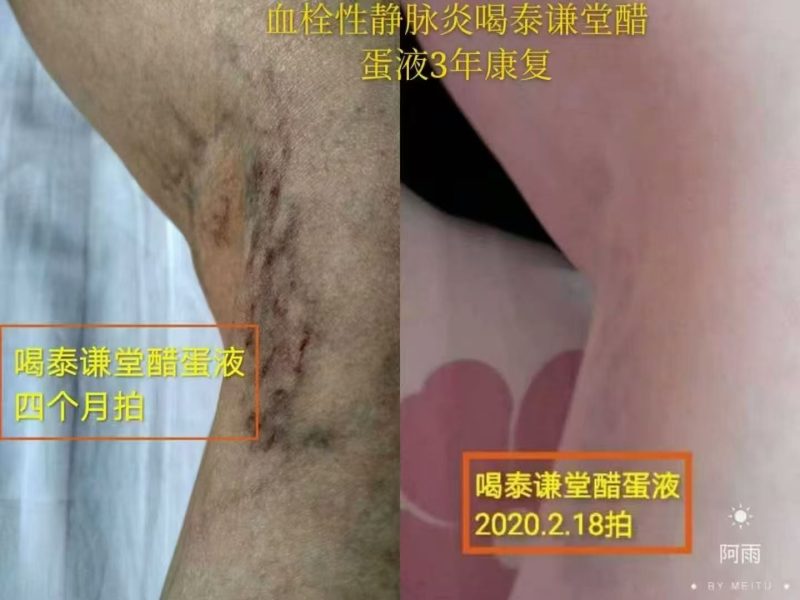 图片[1]-血栓性静脉炎喝泰谦堂醋蛋液3年康复-醋蛋液案例交流分享圈子社区-智健家
