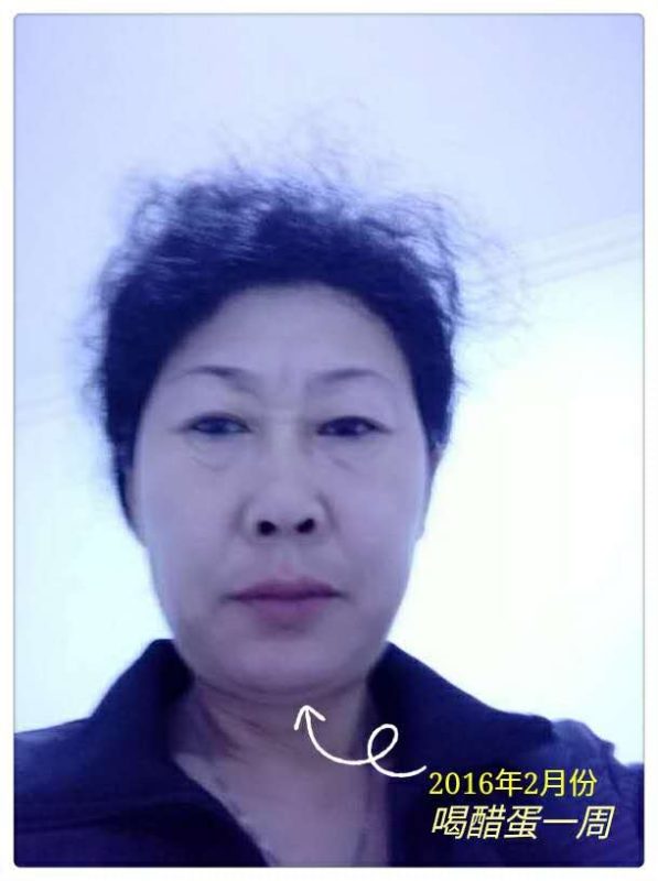 图片[1]-我和我的老干妈：声带息肉、胆管结石、顽固性便秘、肠息肉、腰间盘突出、膝关节骨刺、滑膜炎…-醋蛋液案例交流分享圈子社区-智健家