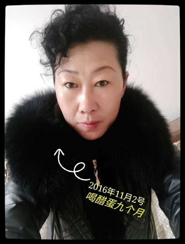 图片[4]-我和我的老干妈：声带息肉、胆管结石、顽固性便秘、肠息肉、腰间盘突出、膝关节骨刺、滑膜炎…-醋蛋液案例交流分享圈子社区-智健家