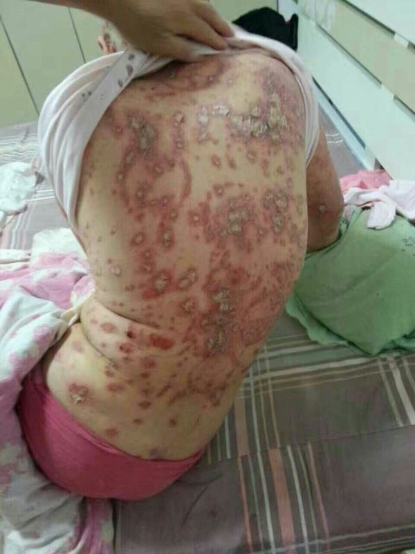 图片[1]-高血压、颈椎病、肝硬化、滑膜炎、皮肤病、风湿、……-醋蛋液案例交流分享圈子社区-智健家