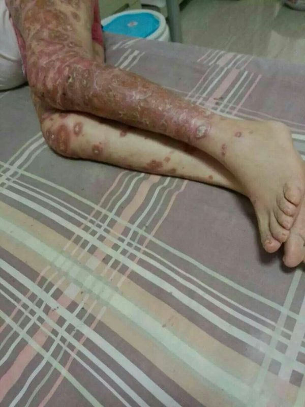 图片[3]-高血压、颈椎病、肝硬化、滑膜炎、皮肤病、风湿、……-醋蛋液案例交流分享圈子社区-智健家