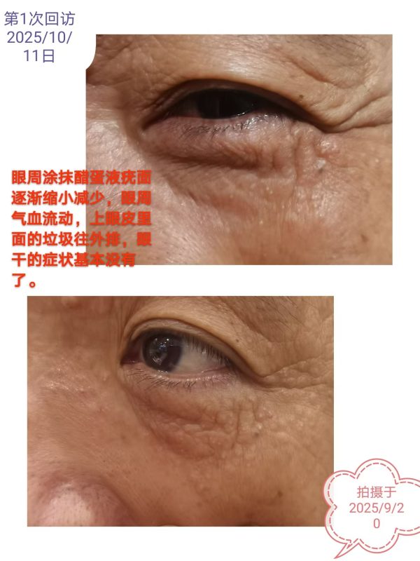 图片[1]-2025年10.17最新反馈：眼周皮肤疣减少，眼睛干涩改善了，白发转黑中，泰谦堂醋蛋归元液谁用谁受益-醋蛋液案例交流分享圈子社区-智健家