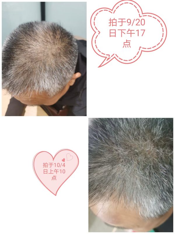 图片[2]-2025年10.17最新反馈：眼周皮肤疣减少，眼睛干涩改善了，白发转黑中，泰谦堂醋蛋归元液谁用谁受益-醋蛋液案例交流分享圈子社区-智健家