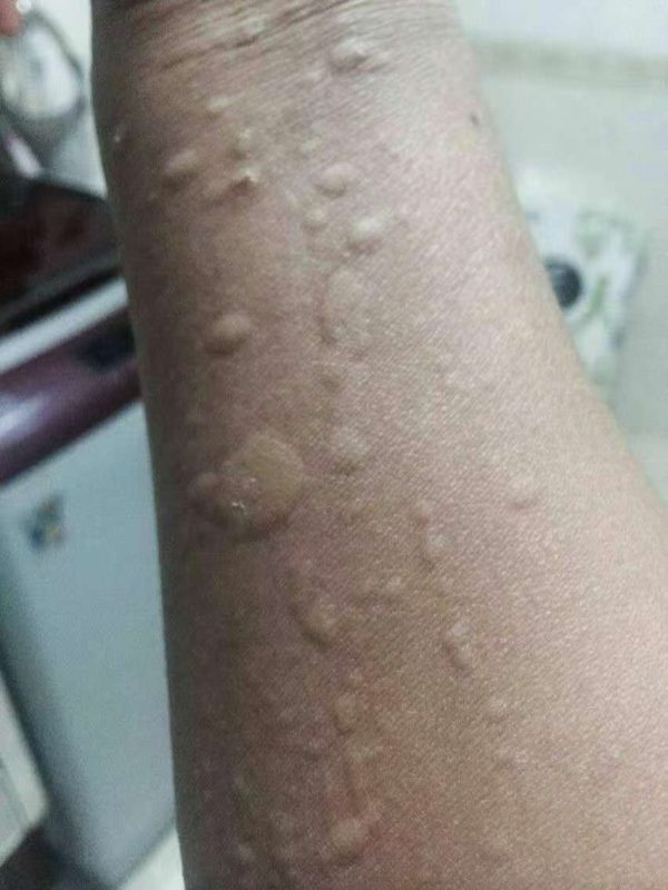 图片[1]-以前我亲自调好一个荨麻疹患者，醋蛋液喝了三盒就好了-醋蛋液案例交流分享圈子社区-智健家