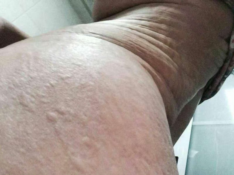 图片[2]-以前我亲自调好一个荨麻疹患者，醋蛋液喝了三盒就好了-醋蛋液案例交流分享圈子社区-智健家
