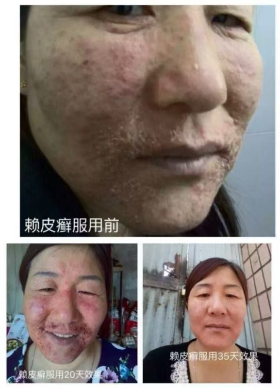 图片[1]-赖皮癣，服用泰谦堂醋蛋液35天的效果-醋蛋液案例交流分享圈子社区-智健家