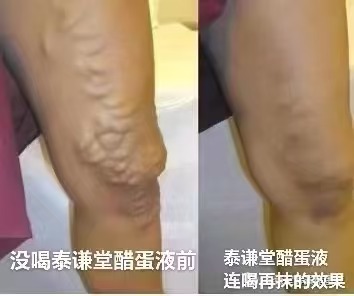 图片[1]-不同人的静脉曲张，通过泰谦堂醋蛋归元液连喝带抹的效果-醋蛋液案例交流分享圈子社区-智健家