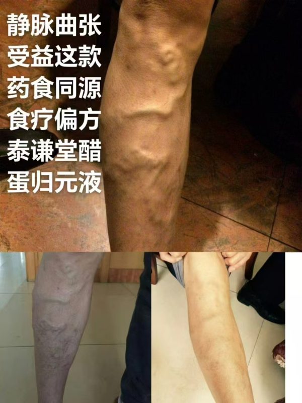 图片[2]-不同人的静脉曲张，通过泰谦堂醋蛋归元液连喝带抹的效果-醋蛋液案例交流分享圈子社区-智健家
