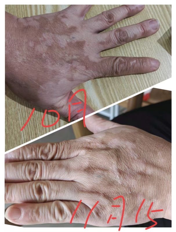 化疗以后皮肤褪色，用醋蛋原液，抹了几天的效果-智健家