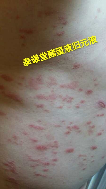 图片[5]-【视频】儿子那年才12岁😭 银屑病（牛皮癣）〔小小醋蛋液，十五天有效，三个月痊愈〕-泰谦堂醋蛋液案例合集圈子社区-智健家