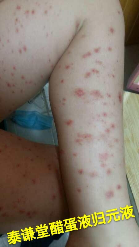 图片[6]-【视频】儿子那年才12岁😭 银屑病（牛皮癣）〔小小醋蛋液，十五天有效，三个月痊愈〕-泰谦堂醋蛋液案例合集圈子社区-智健家