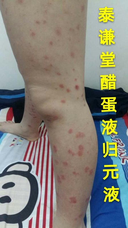 图片[7]-【视频】儿子那年才12岁😭 银屑病（牛皮癣）〔小小醋蛋液，十五天有效，三个月痊愈〕-泰谦堂醋蛋液案例合集圈子社区-智健家