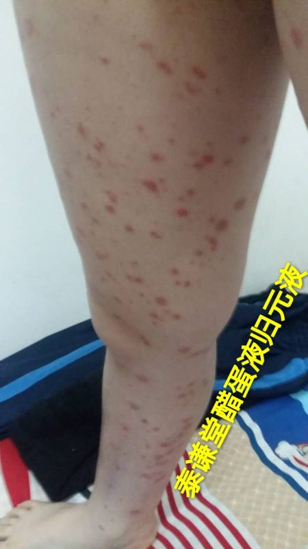 图片[8]-【视频】儿子那年才12岁😭 银屑病（牛皮癣）〔小小醋蛋液，十五天有效，三个月痊愈〕-泰谦堂醋蛋液案例合集圈子社区-智健家