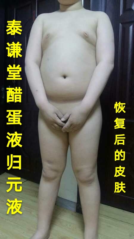 图片[9]-【视频】儿子那年才12岁😭 银屑病（牛皮癣）〔小小醋蛋液，十五天有效，三个月痊愈〕-泰谦堂醋蛋液案例合集圈子社区-智健家