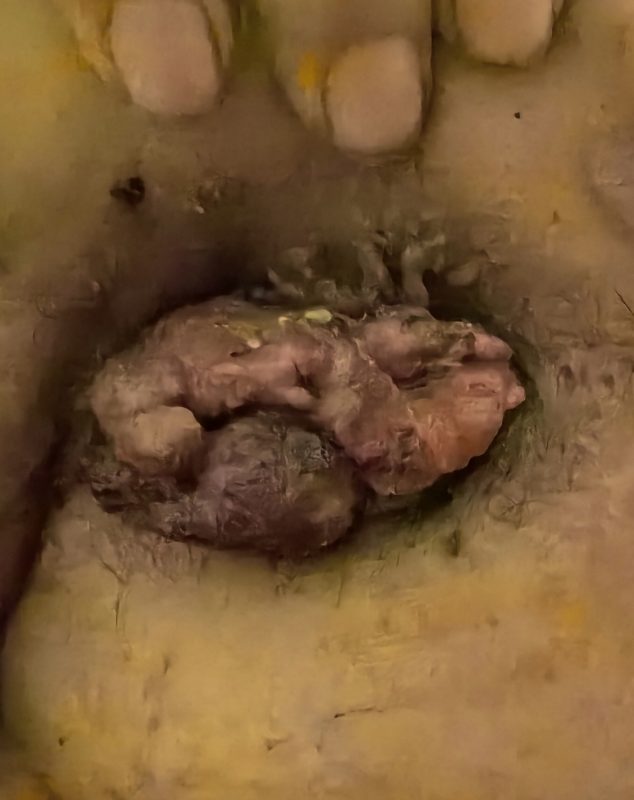 王哥的菜花状直肠癌，长在肛门外，用醋蛋液一周后的反馈-智健家