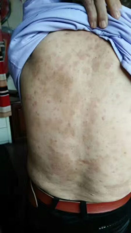 图片[5]-一个内蒙古舍得老师服务的一个严重牛皮癣患者-泰谦堂醋蛋液案例合集圈子社区-智健家