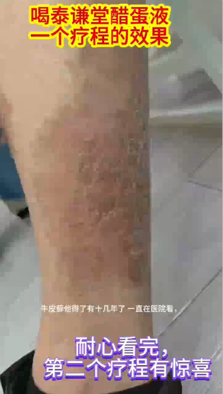 【视频】王先生主动联系要喝泰谦堂醋蛋液的牛皮癣效果-智健家