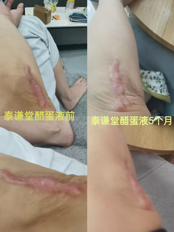喝泰谦堂醋蛋液5个月，2年的疤痕平了好多，也不痒了-智健家