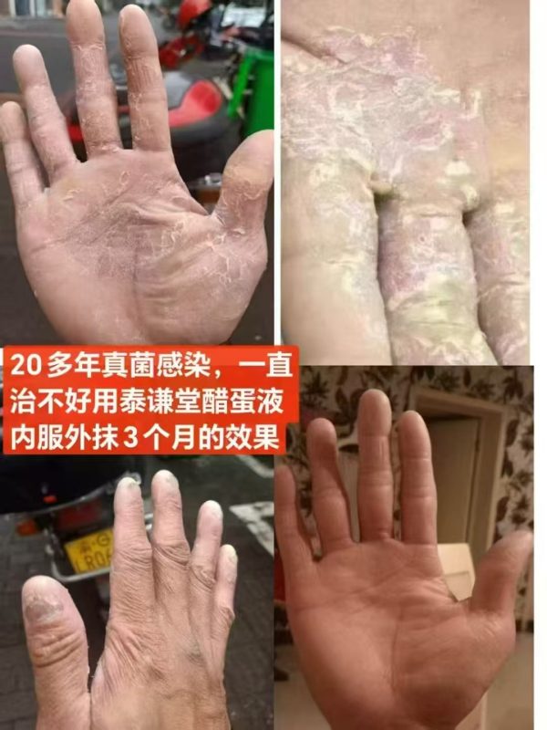 20多年真菌感染，一直治不好，用泰谦堂醋蛋归元液，内服外抹3个月的效果。-智健家