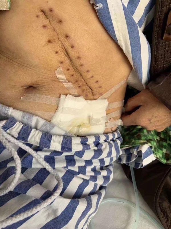 胰腺肿瘤 多次住院，自己亲身的经历，后悔没有早点用上泰谦堂醋蛋液-智健家