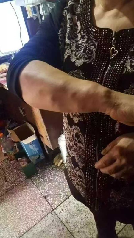 当脂肪瘤 遇上泰谦堂醋蛋归元液 那都不叫事儿了-智健家