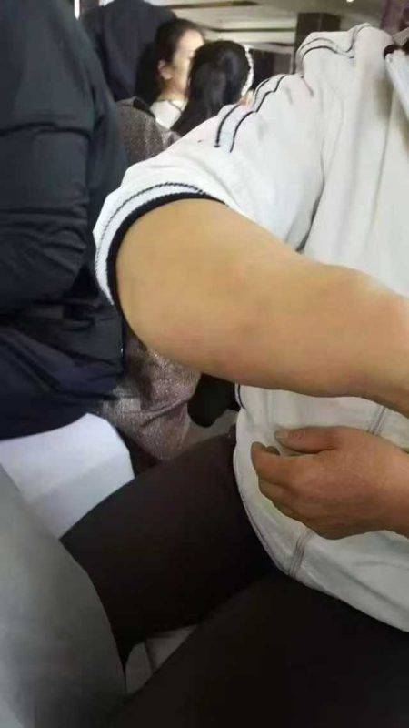 当脂肪瘤 遇上泰谦堂醋蛋归元液 那都不叫事儿了-智健家