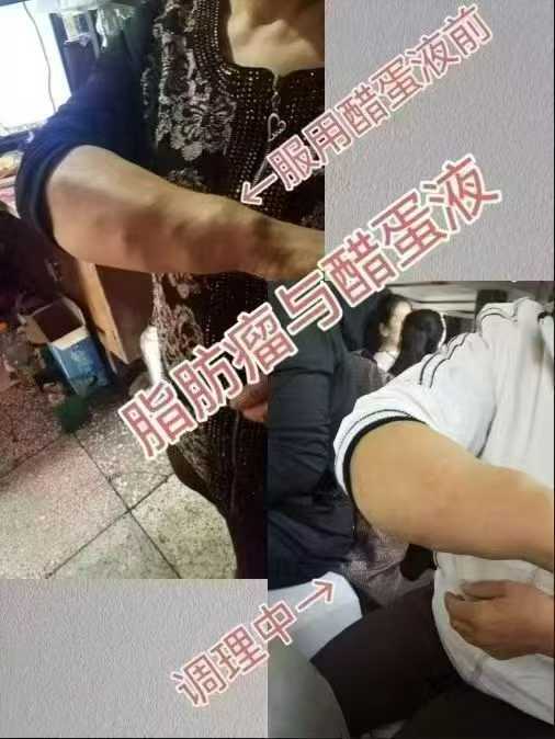 当脂肪瘤 遇上泰谦堂醋蛋归元液 那都不叫事儿了-智健家