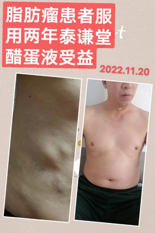脂肪瘤，用了两年泰谦堂醋蛋液受益-智健家
