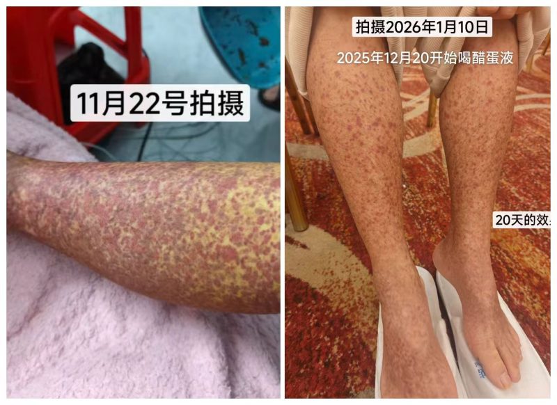 【视频】过敏性紫癜，用泰谦堂醋蛋归元液20天的效果-智健家